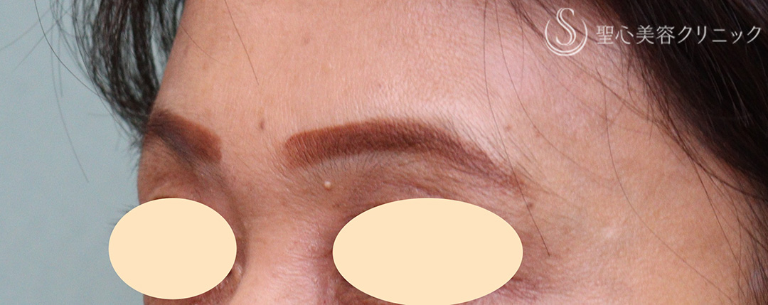 【50代女性・眉間のしわ】プレミアムPRP皮膚再生療法（1年3か月後） After 
