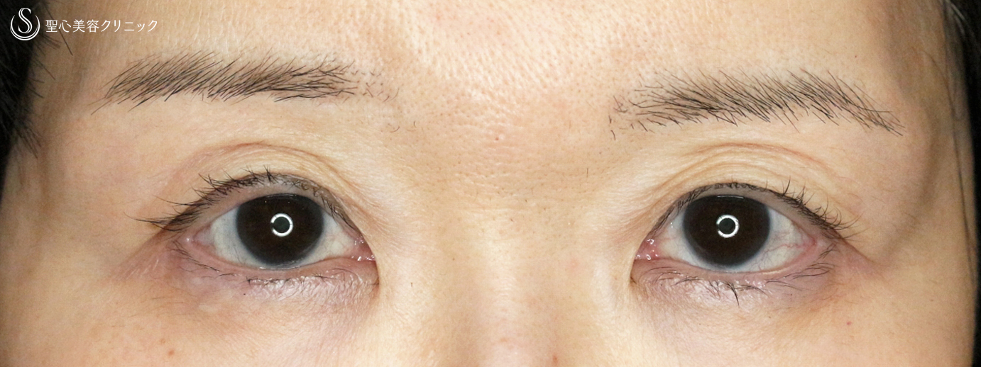 【50代女性・コンタクトレンズによる下垂に複合治療】切らない眼瞼下垂+α法＆眉下リフト（5年後） After 