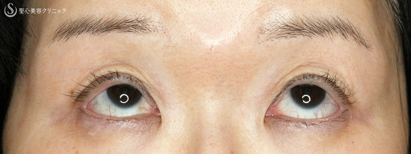 【50代女性・コンタクトレンズによる下垂に複合治療】切らない眼瞼下垂+α法＆眉下リフト（5年後） After 