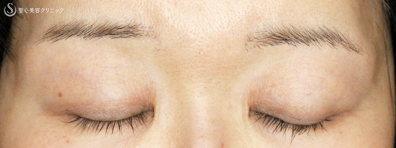 【50代女性・コンタクトレンズによる下垂に複合治療】切らない眼瞼下垂+α法＆眉下リフト（5年後） After 