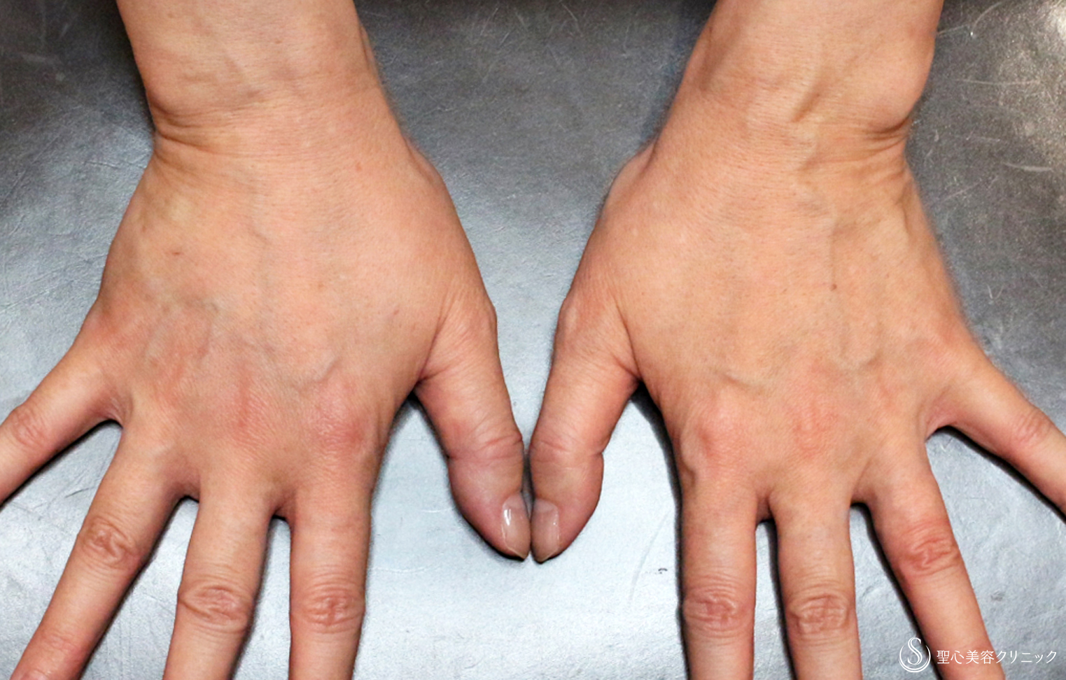 【40代女性・別次元の手の甲の若返り】プレミアムPRP皮膚再生療法（11年後） After 