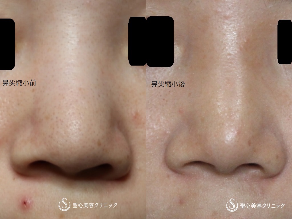 【30代女性・真っすぐな鼻筋に】鼻尖縮小のちGメッシュ（直後） Before 