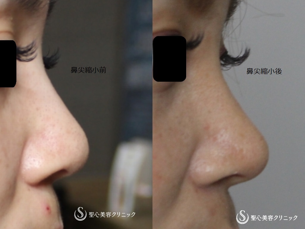 【30代女性・真っすぐな鼻筋に】鼻尖縮小のちGメッシュ（直後） Before 
