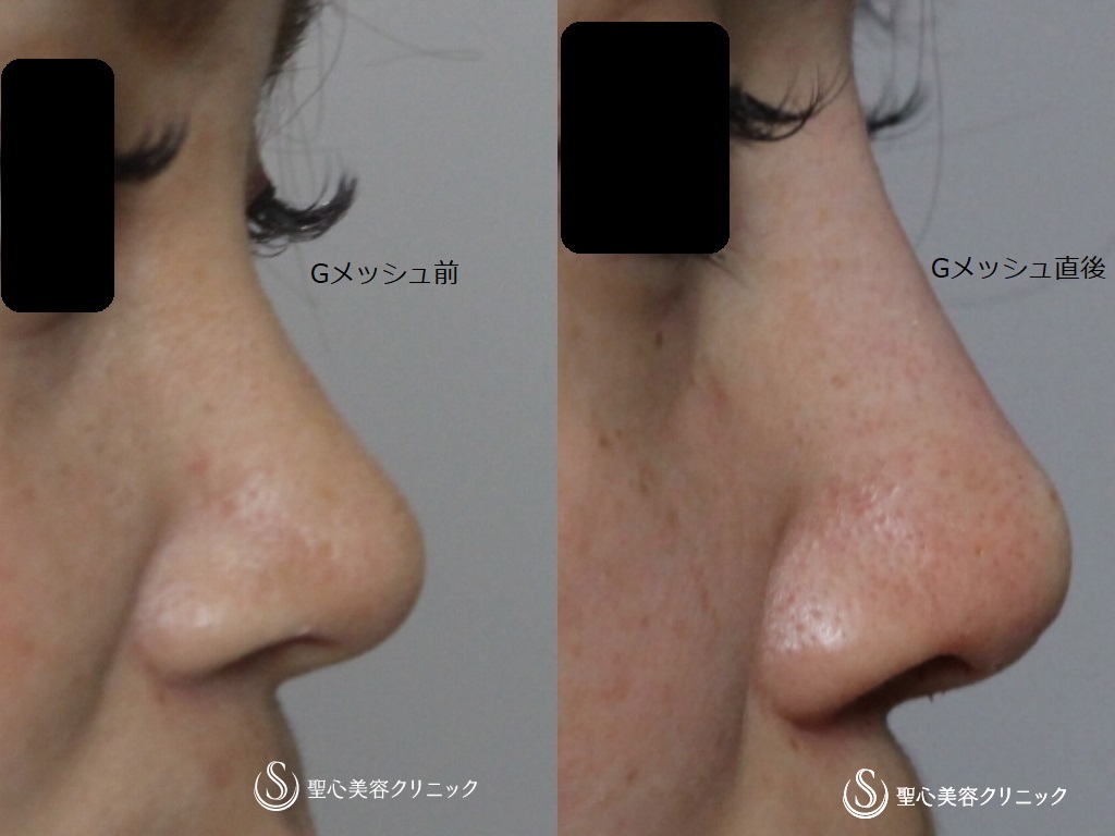 【30代女性・真っすぐな鼻筋に】鼻尖縮小のちGメッシュ（直後） After 