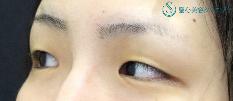 【30代女性・スッキリとした自然な二重に】二重切開術＋脱脂術（1ヶ月後） Before 