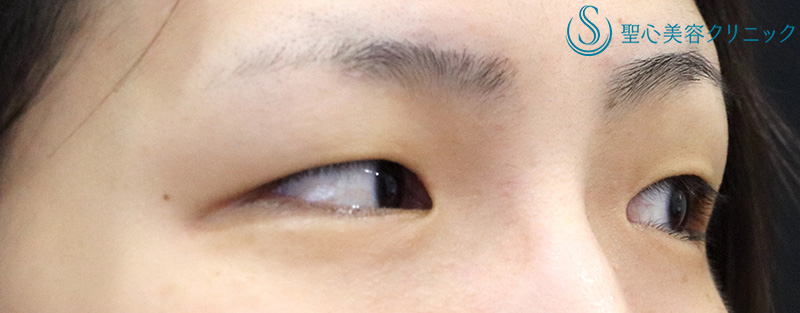 【30代女性・スッキリとした自然な二重に】二重切開術＋脱脂術（1ヶ月後） Before 