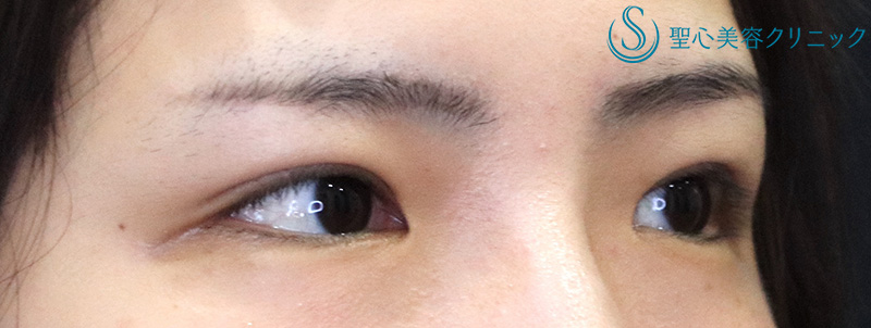 【30代女性・スッキリとした自然な二重に】二重切開術＋脱脂術（1ヶ月後） After 
