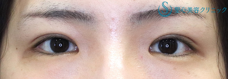 【30代女性・スッキリとした自然な二重に】二重切開術＋脱脂術（1ヶ月後） After 