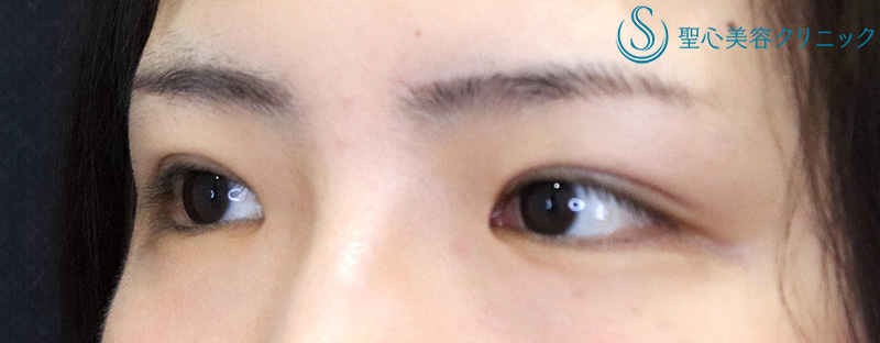 【30代女性・スッキリとした自然な二重に】二重切開術＋脱脂術（1ヶ月後） After 