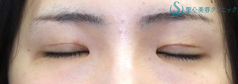 【30代女性・スッキリとした自然な二重に】二重切開術＋脱脂術（1ヶ月後） After 