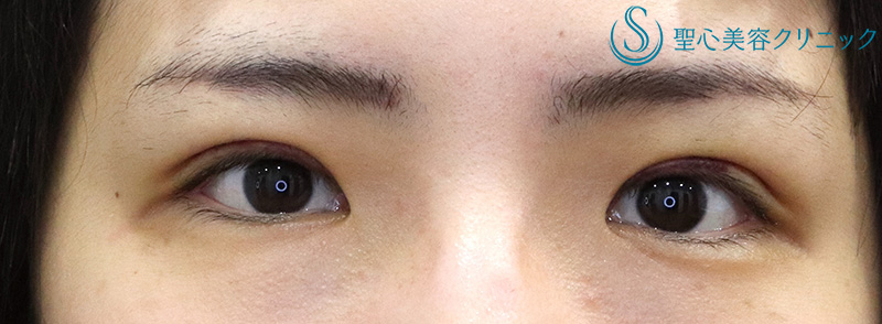 【30代女性・スッキリとした自然な二重に】二重切開術＋脱脂術（1ヶ月後） After 