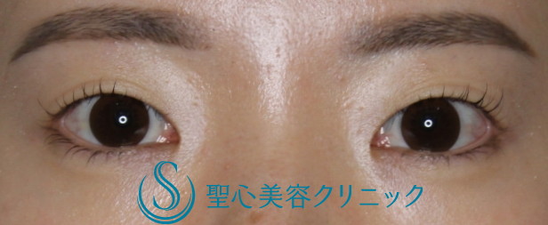 【20代女性・不安定で浅い二重をクッキリさせて目力UP】二重マイクロメソッド+α埋没法（３点留め）（7日後） Before 