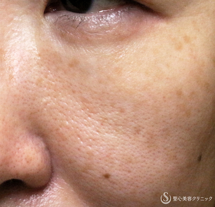 【40代女性・目まわりのホクロを取る】電気凝固法（15年後） After 