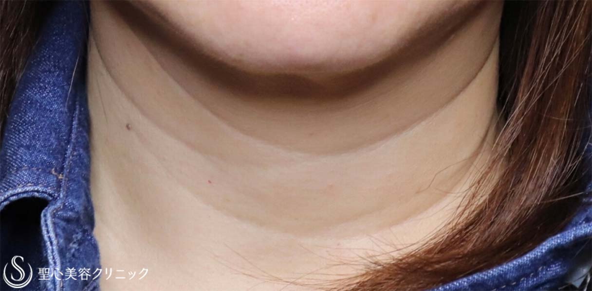 【50代女性・首の横ジワを治したい】プレミアムPRP皮膚再生療法（1年後） Before 