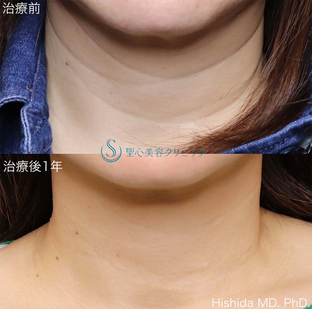 【50代女性・首の横ジワを治したい】プレミアムPRP皮膚再生療法（1年後） After 