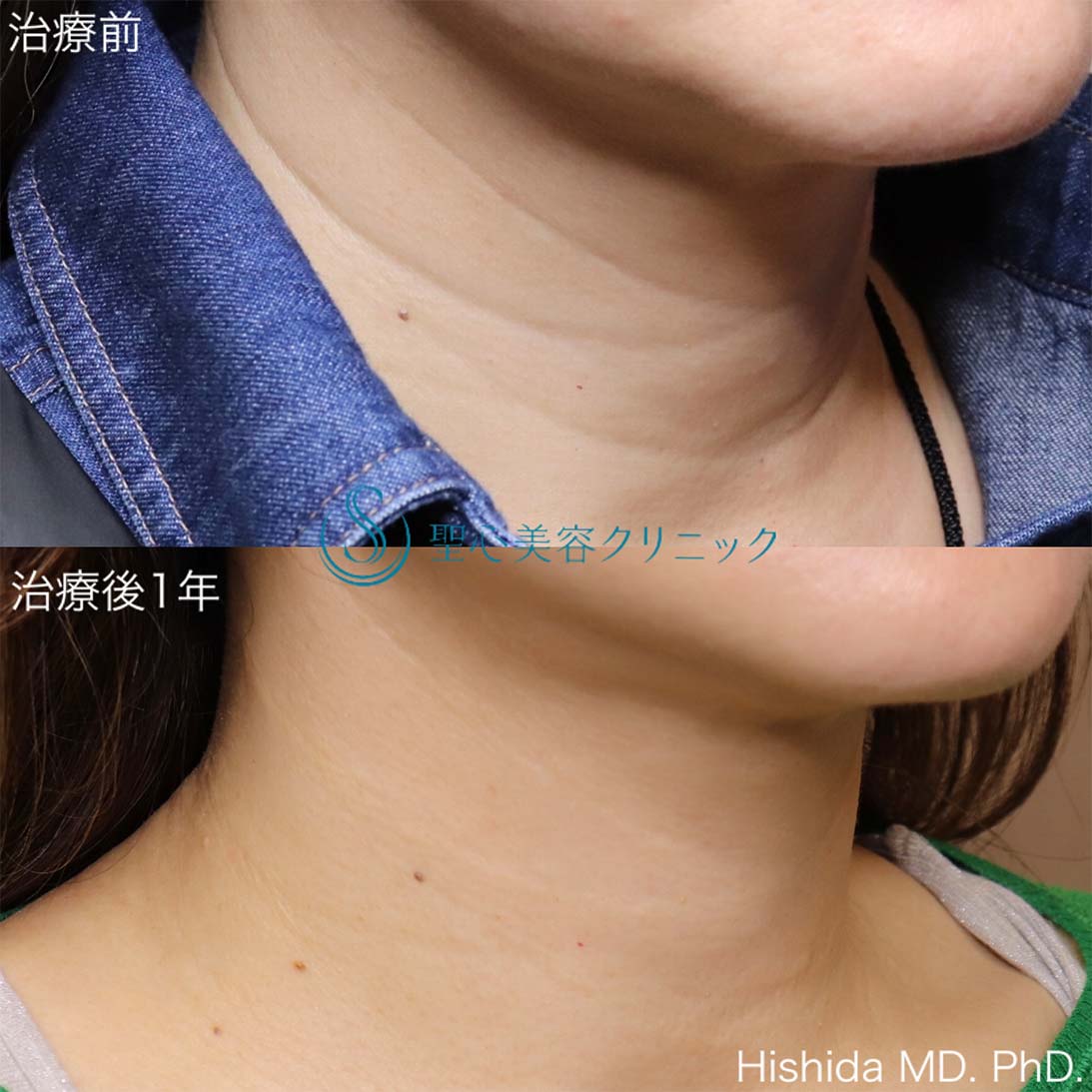 【50代女性・首の横ジワを治したい】プレミアムPRP皮膚再生療法（1年後） After 