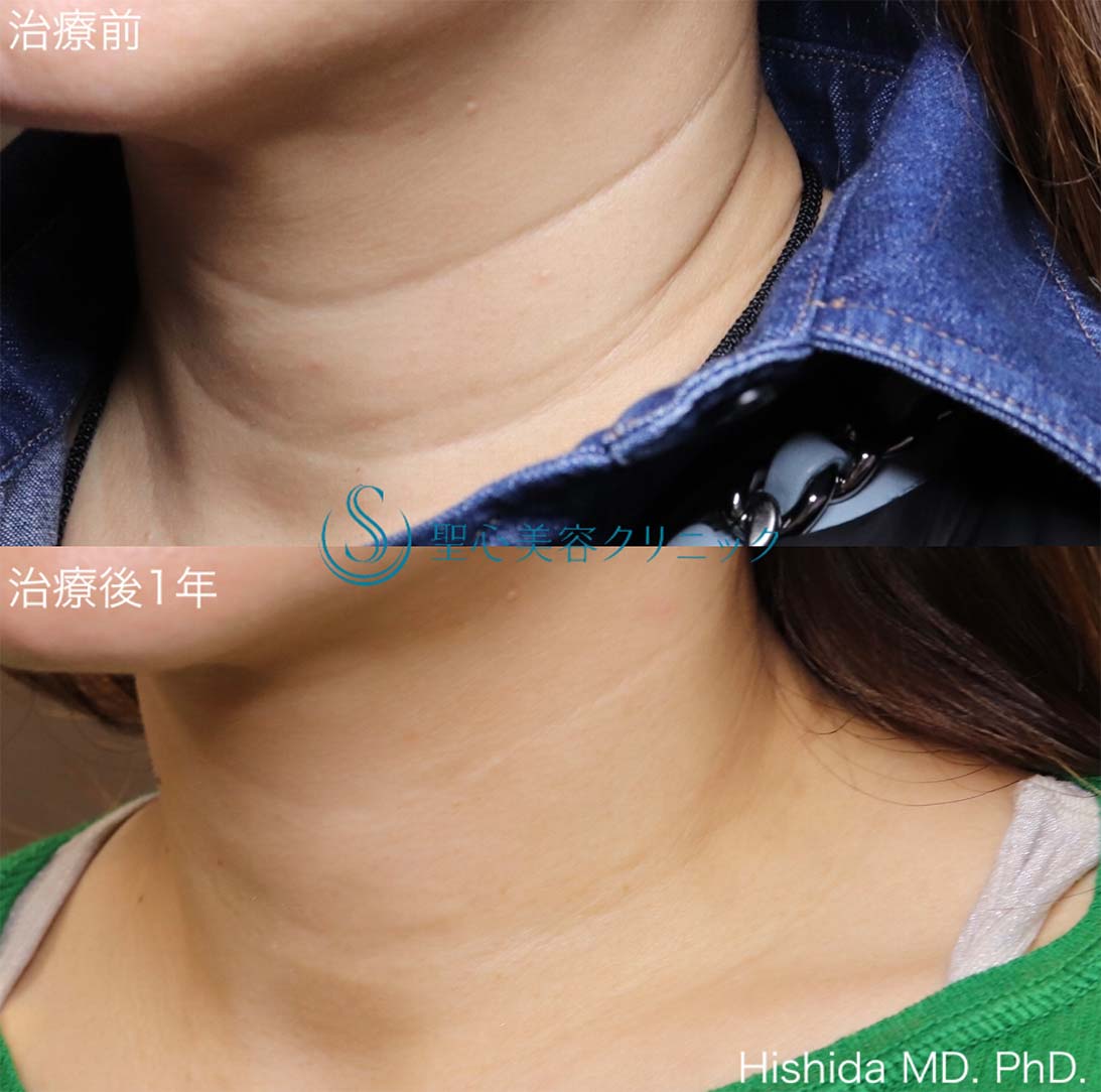 【50代女性・首の横ジワを治したい】プレミアムPRP皮膚再生療法（1年後） After 