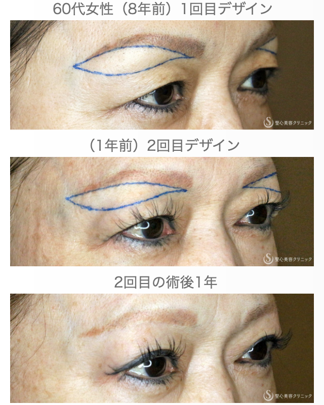 【60代女性・20年前の目元に戻してみました】眉下リフト+α 2回目（1年後） After 