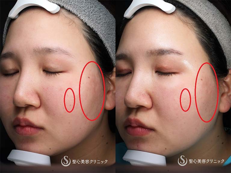 【20代女性・色素沈着が気になる】ルビーフラクショナルレーザー（ADM治療１回処置後） After 