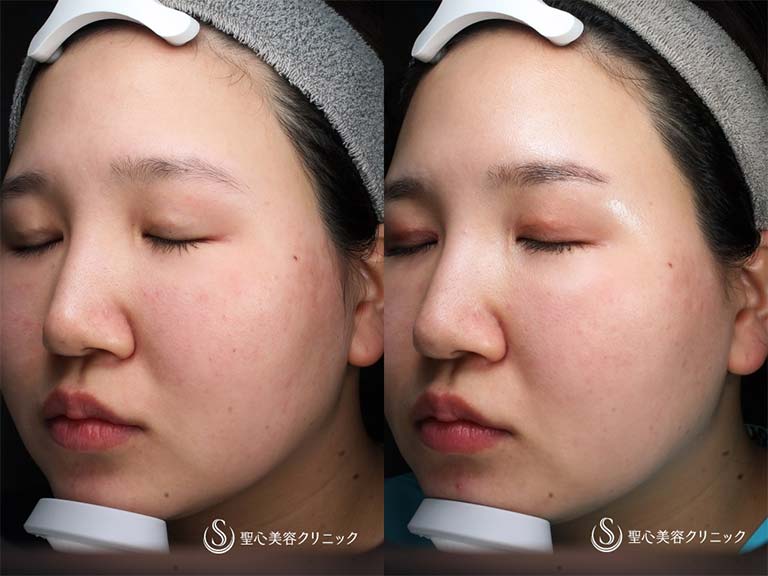 【20代女性・色素沈着が気になる】ルビーフラクショナルレーザー（ADM治療１回処置後） After 