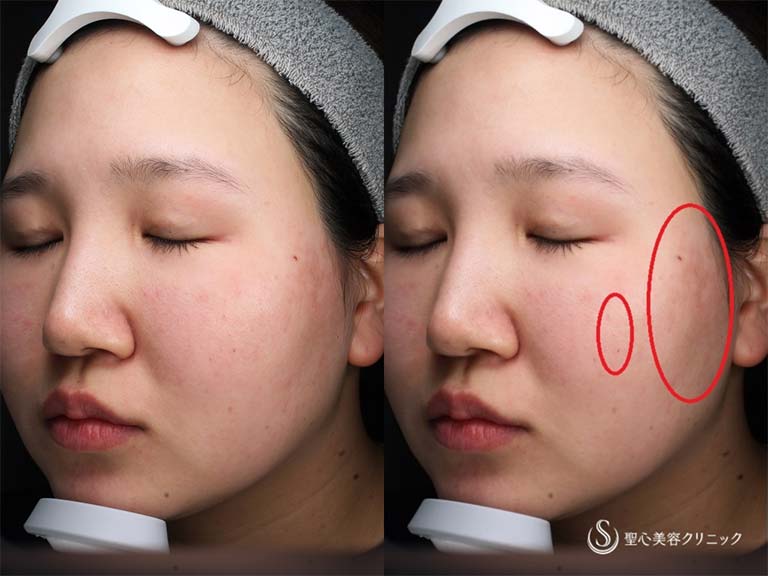 【20代女性・色素沈着が気になる】ルビーフラクショナルレーザー（ADM治療１回処置後） Before 