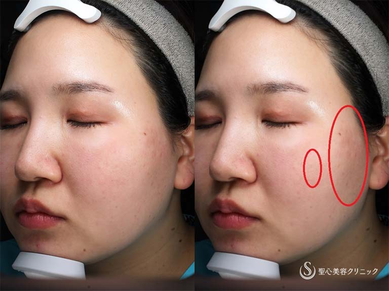 【20代女性・色素沈着が気になる】ルビーフラクショナルレーザー（ADM治療１回処置後） After 