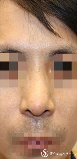 【30代男性・カッコいいお鼻に】 鼻中隔延長（肋軟骨）＋鼻尖形成（耳介軟骨・肋軟骨膜）（術後2ヶ月） After 