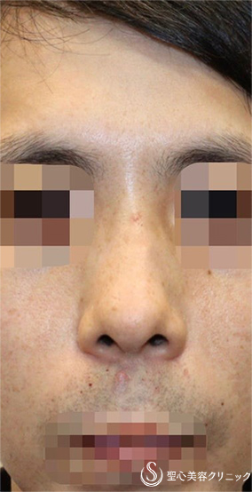 【30代男性・カッコいいお鼻に】 鼻中隔延長（肋軟骨）＋鼻尖形成（耳介軟骨・肋軟骨膜）（術後2ヶ月） Before 