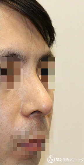 【30代男性・カッコいいお鼻に】 鼻中隔延長（肋軟骨）＋鼻尖形成（耳介軟骨・肋軟骨膜）（術後2ヶ月） After 