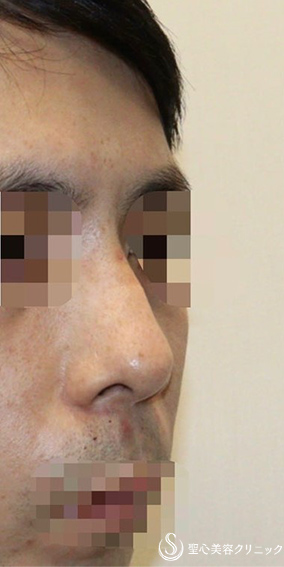【30代男性・カッコいいお鼻に】 鼻中隔延長（肋軟骨）＋鼻尖形成（耳介軟骨・肋軟骨膜）（術後2ヶ月） Before 