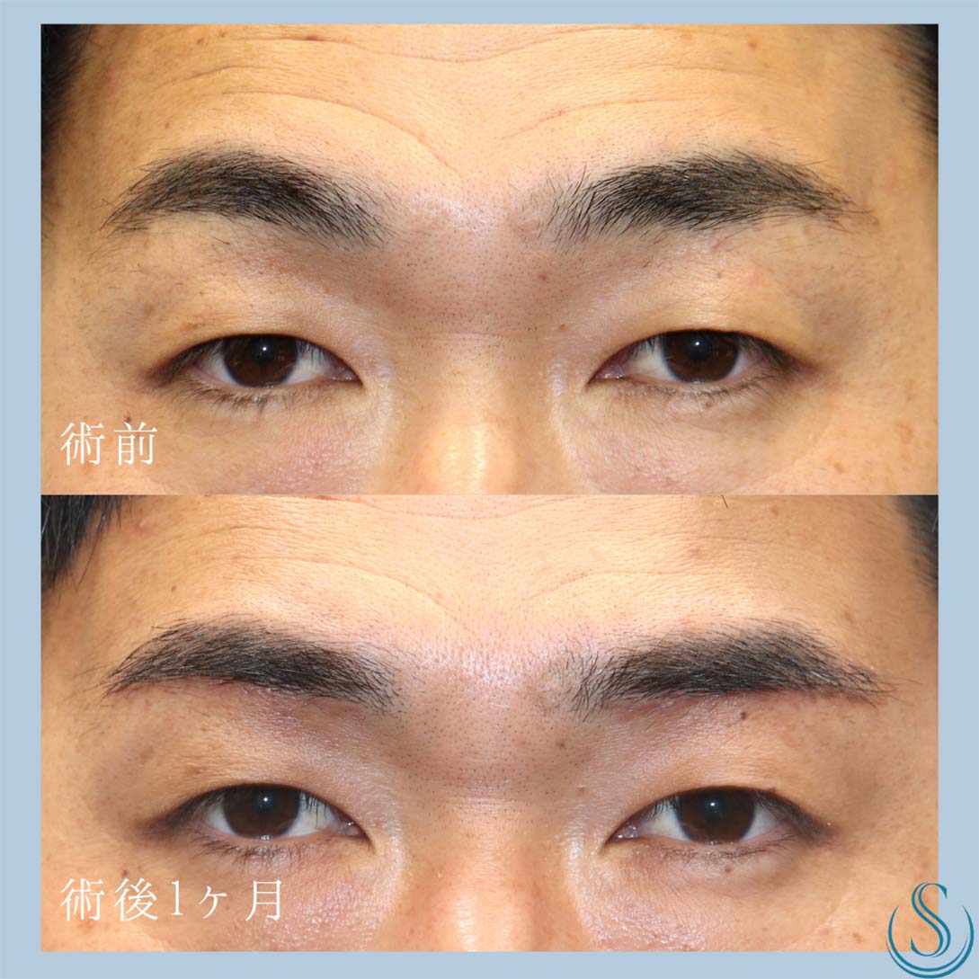【30代男性・眉下リフトで目元をすっきりと】 眉下切開法（眉下リフト）（1ヶ月後） Before 