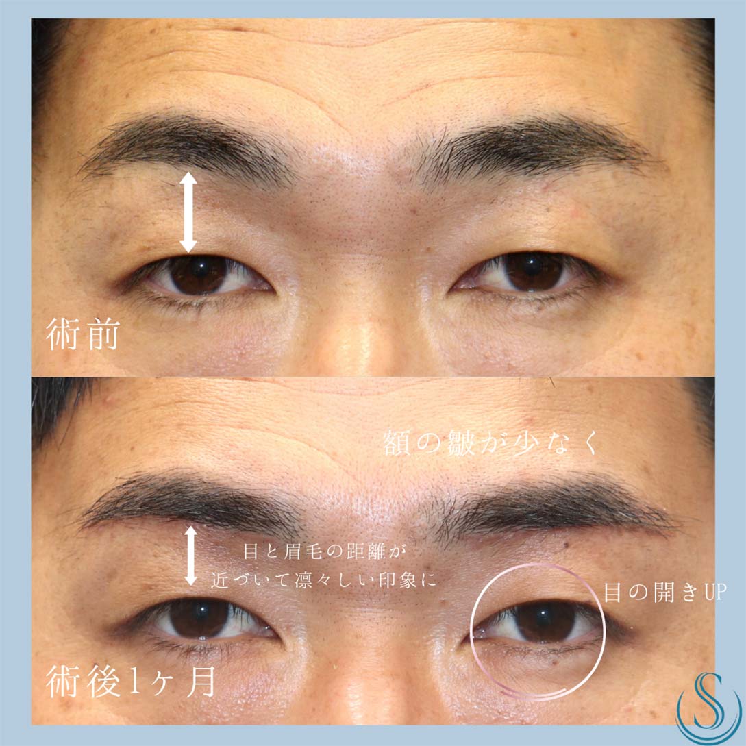【30代男性・眉下リフトで目元をすっきりと】 眉下切開法（眉下リフト）（1ヶ月後） After 