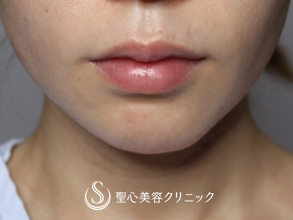 【20代女性・印象の良い口元に】プレミアム口角挙上（術後4か月） Before 