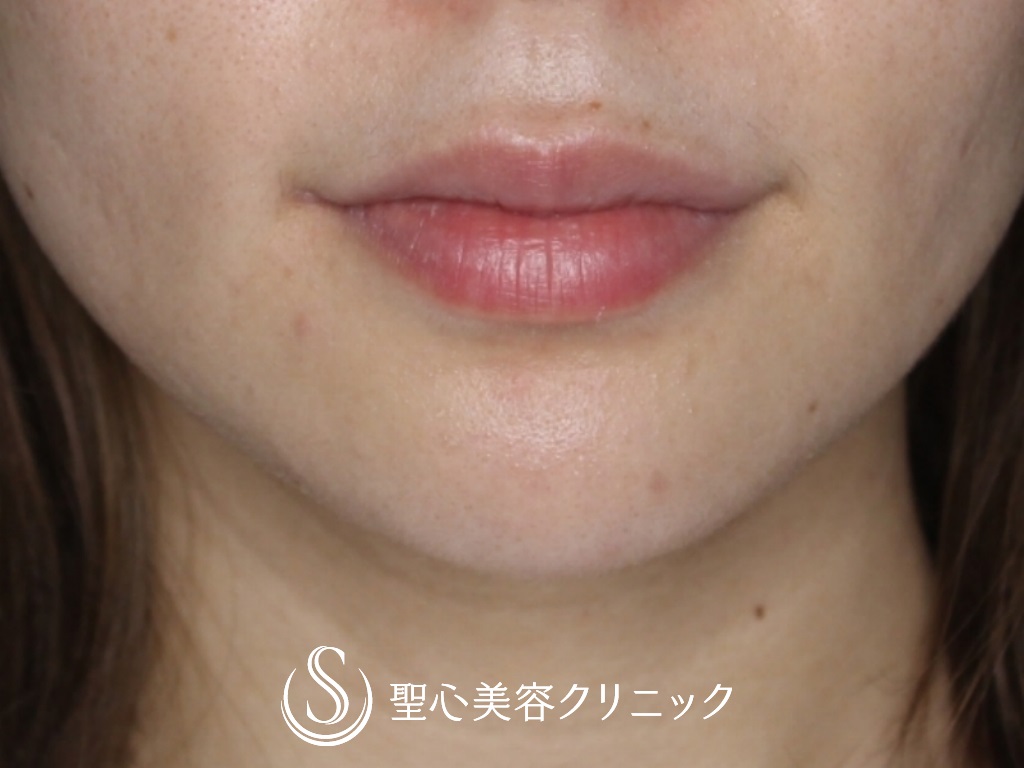 【20代女性・印象の良い口元に】プレミアム口角挙上（術後4か月） After 