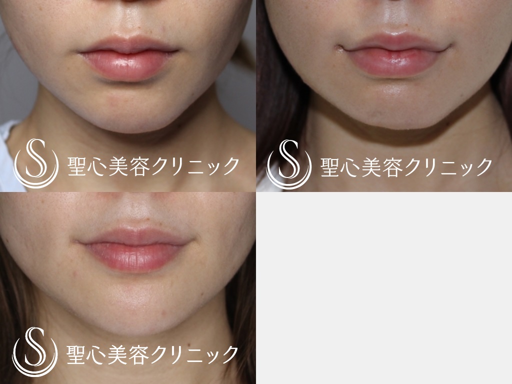 【20代女性・印象の良い口元に】プレミアム口角挙上（術後4か月） After 