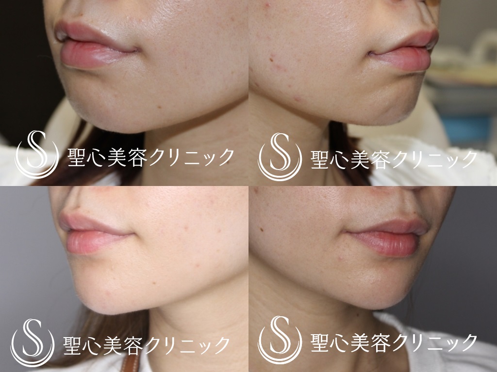 【20代女性・印象の良い口元に】プレミアム口角挙上（術後4か月） After 