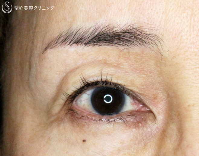【50代女性・ハードコンタクトレンズ眼瞼下垂の長期経過】切らない眼瞼下垂+α法（11年後） After 