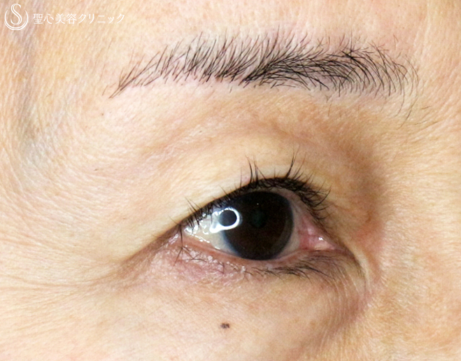 【50代女性・ハードコンタクトレンズ眼瞼下垂の長期経過】切らない眼瞼下垂+α法（11年後） After 