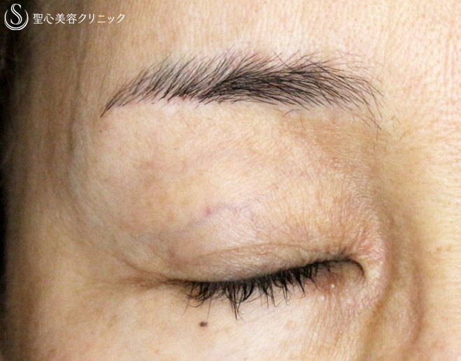 【50代女性・ハードコンタクトレンズ眼瞼下垂の長期経過】切らない眼瞼下垂+α法（11年後） After 