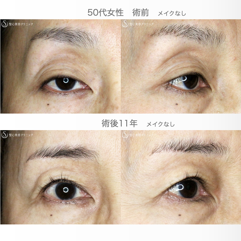 【50代女性・ハードコンタクトレンズ眼瞼下垂の長期経過】切らない眼瞼下垂+α法（11年後） After 