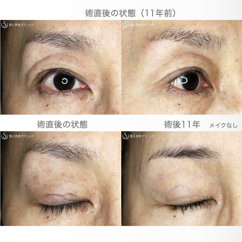 【50代女性・ハードコンタクトレンズ眼瞼下垂の長期経過】切らない眼瞼下垂+α法（11年後） After 