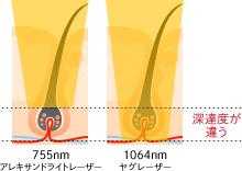 ②効率よく脱毛