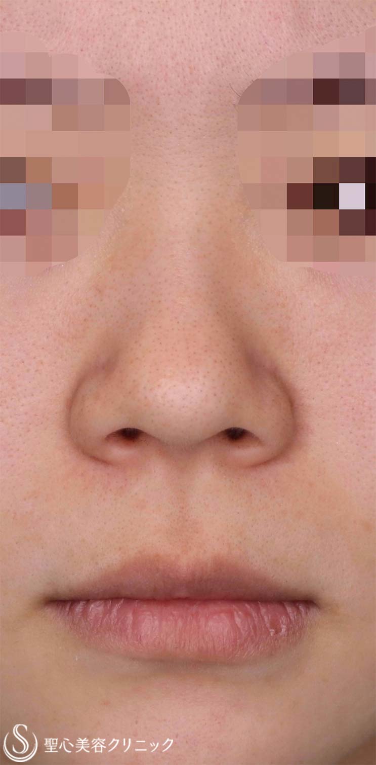 【20代女性・整形感が出ないように小鼻を小さくしたい！！笑った時に小鼻が広がらないようにしたい！！】小鼻縮小術＋側頭筋膜移植（術後1ヶ月） Before 