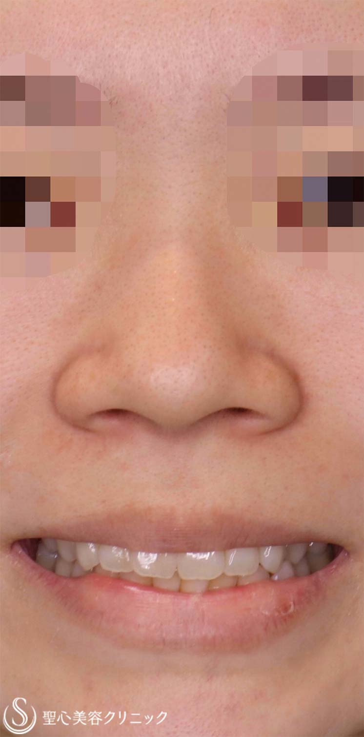 【20代女性・整形感が出ないように小鼻を小さくしたい！！笑った時に小鼻が広がらないようにしたい！！】小鼻縮小術＋側頭筋膜移植（術後1ヶ月） Before 