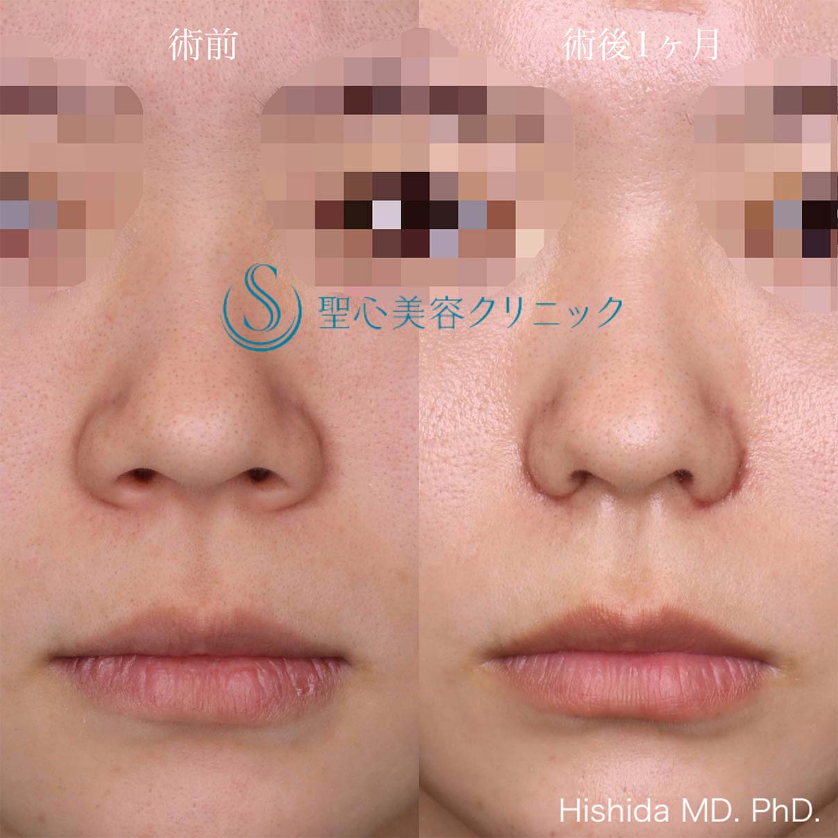 【20代女性・整形感が出ないように小鼻を小さくしたい！！笑った時に小鼻が広がらないようにしたい！！】小鼻縮小術＋側頭筋膜移植（術後1ヶ月） After 
