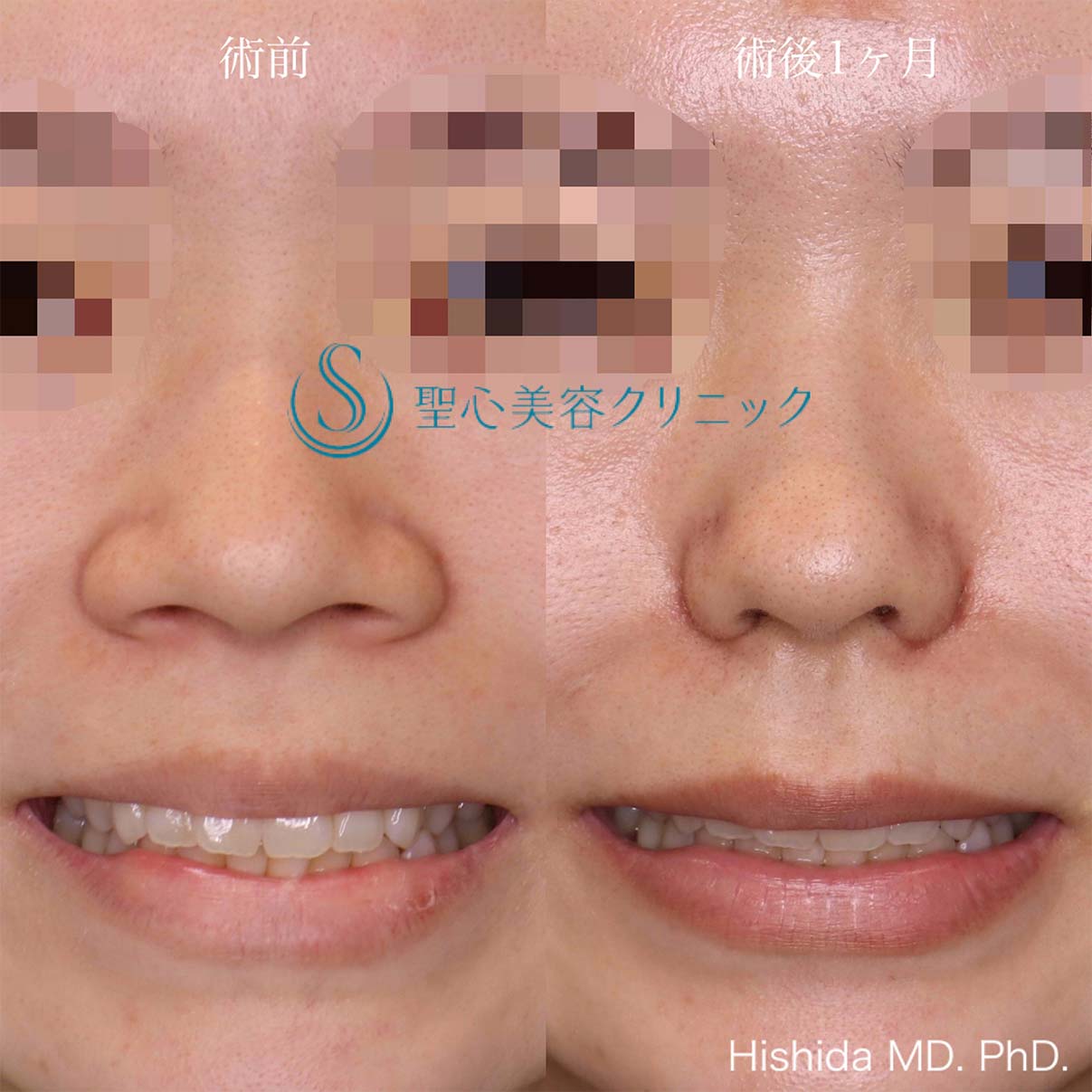【20代女性・整形感が出ないように小鼻を小さくしたい！！笑った時に小鼻が広がらないようにしたい！！】小鼻縮小術＋側頭筋膜移植（術後1ヶ月） After 