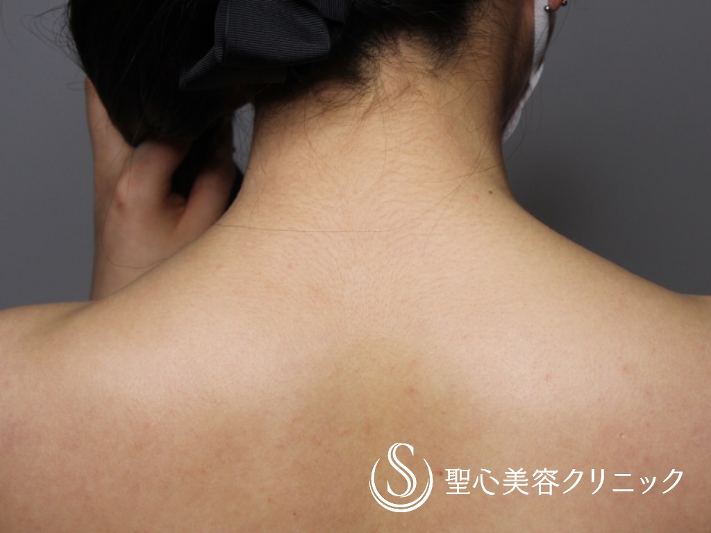 【20代女性・肩凝りの改善&肩周りを華奢に】肩ボトックス（１ヶ月後） Before 