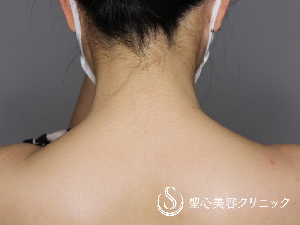 【20代女性・肩凝りの改善&肩周りを華奢に】肩ボトックス（１ヶ月後） After 