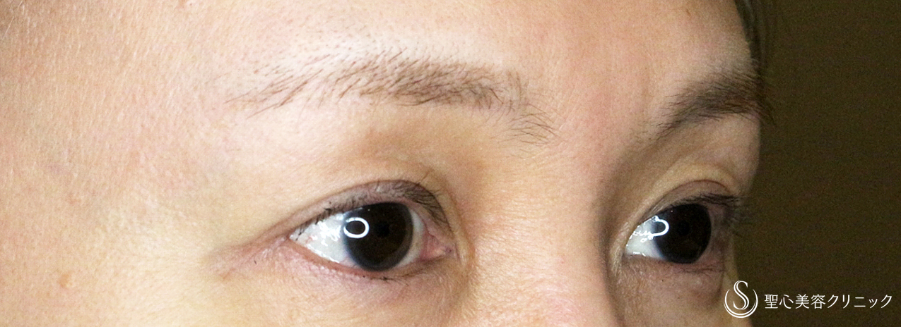 【40代女性・整形ではなく10年前の目元に戻す】眉下リフト+α単独（1年後） After 