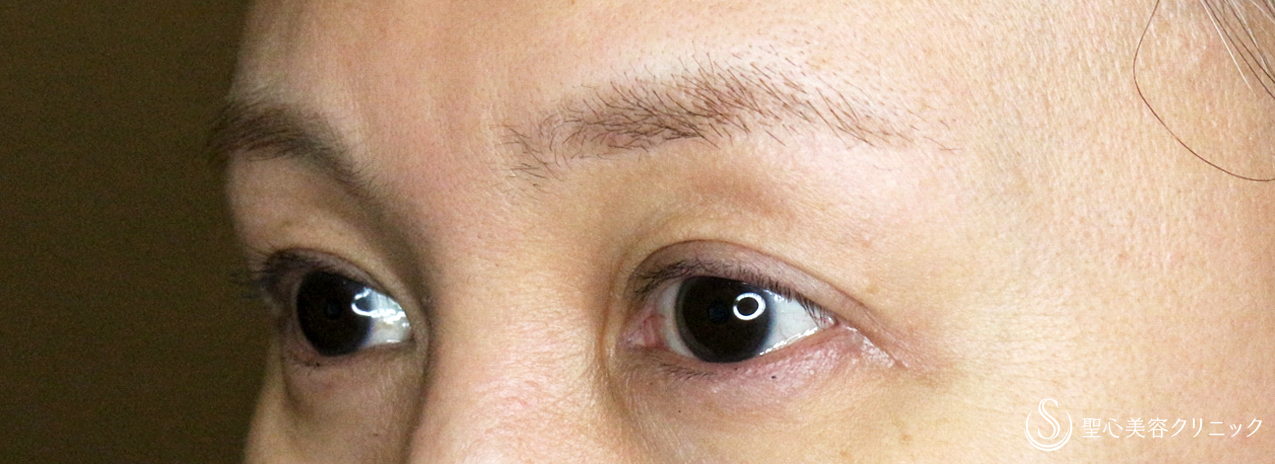 【40代女性・整形ではなく10年前の目元に戻す】眉下リフト+α単独（1年後） After 